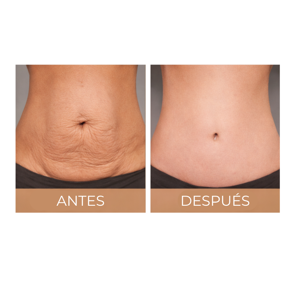 Crema de colágeno anticelulítica